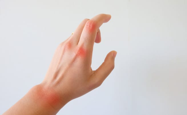 Dieci rimedi naturali per combattere l'artrite